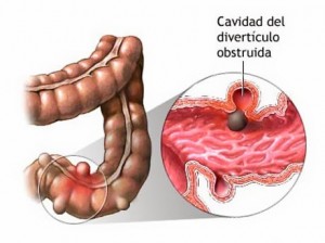 Los DIVERTICULOS son pequeñas bolsas que se forman en la pared del intestino, principalmente en el colon.